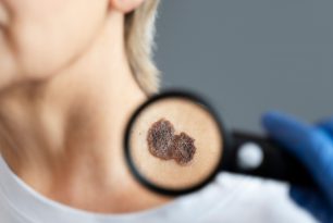 Câncer de pele representa 33% dos casos desta doença no Brasil; saiba se prevenir